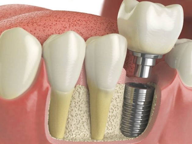 Implante dental en Xàtiva